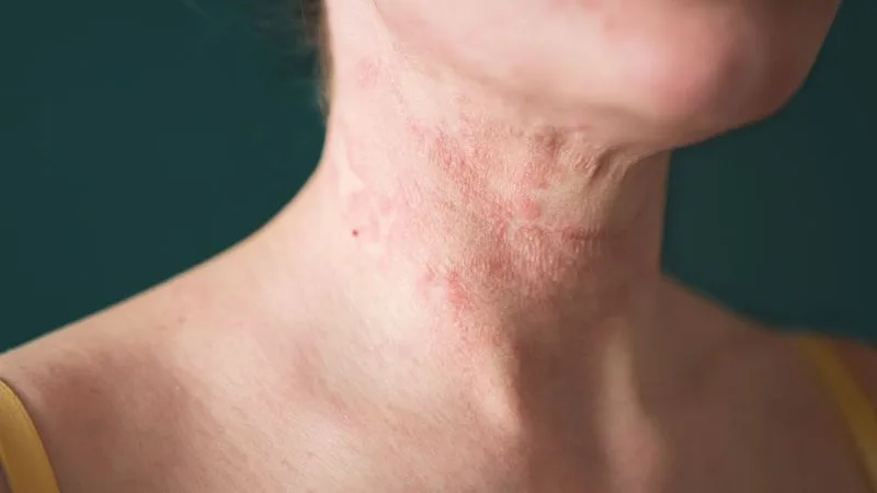 Hải sản giàu đạm, thịt đỏ và đồ ăn chiên rán là những nhóm thực phẩm dễ kích thích phản ứng viêm bùng phát.