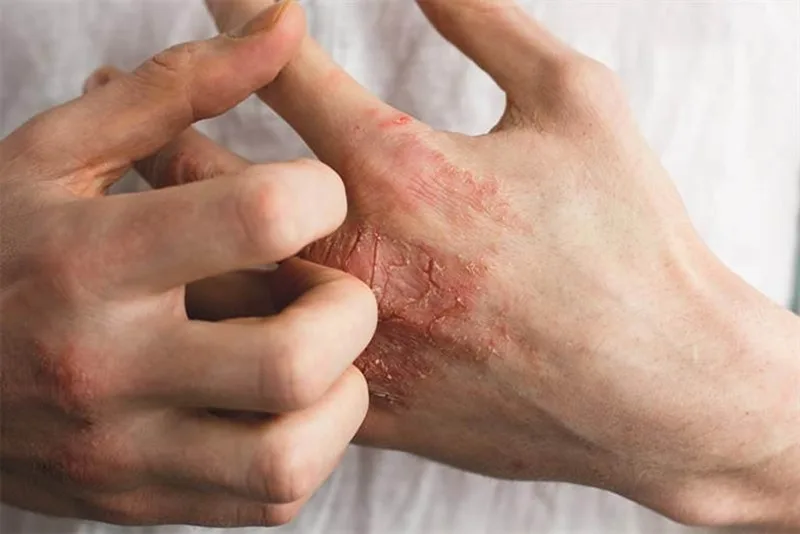 Nên hạn chế các món ăn từ gạo nếp và dưa cà muối chua để tránh làm tổn thương da bị mưng mủ, lâu lành.