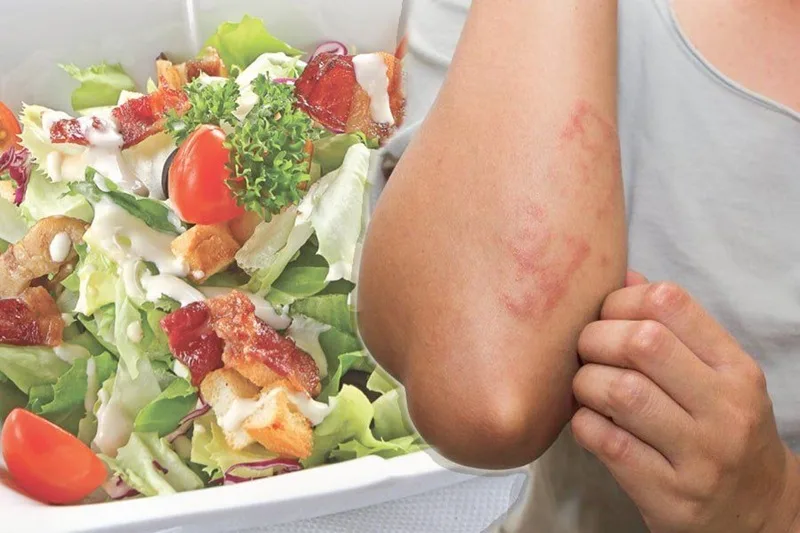 Viêm da cơ địa gây ra các triệu chứng ngứa ngáy, khô ráp và bong tróc da, chịu ảnh hưởng lớn từ chế độ ăn uống.